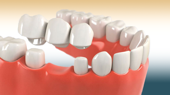 Dental bridge