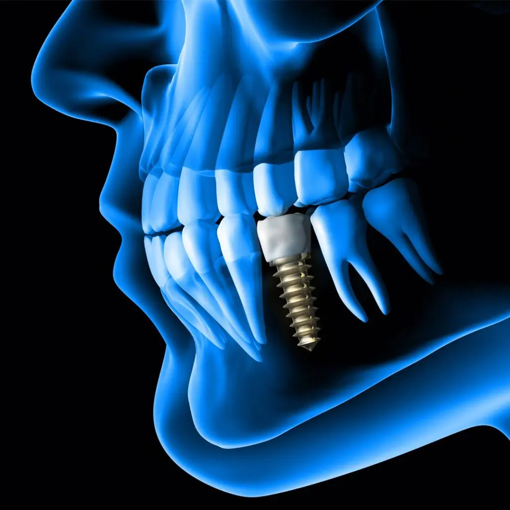 Dental Implant