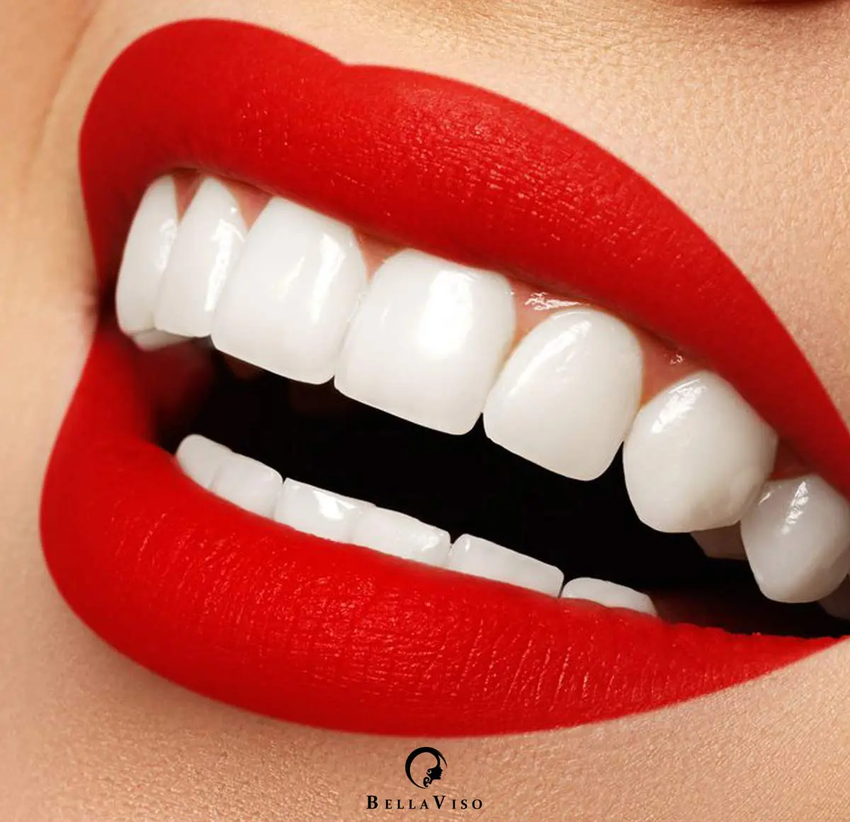 Dental Veneer Dubai UAE
